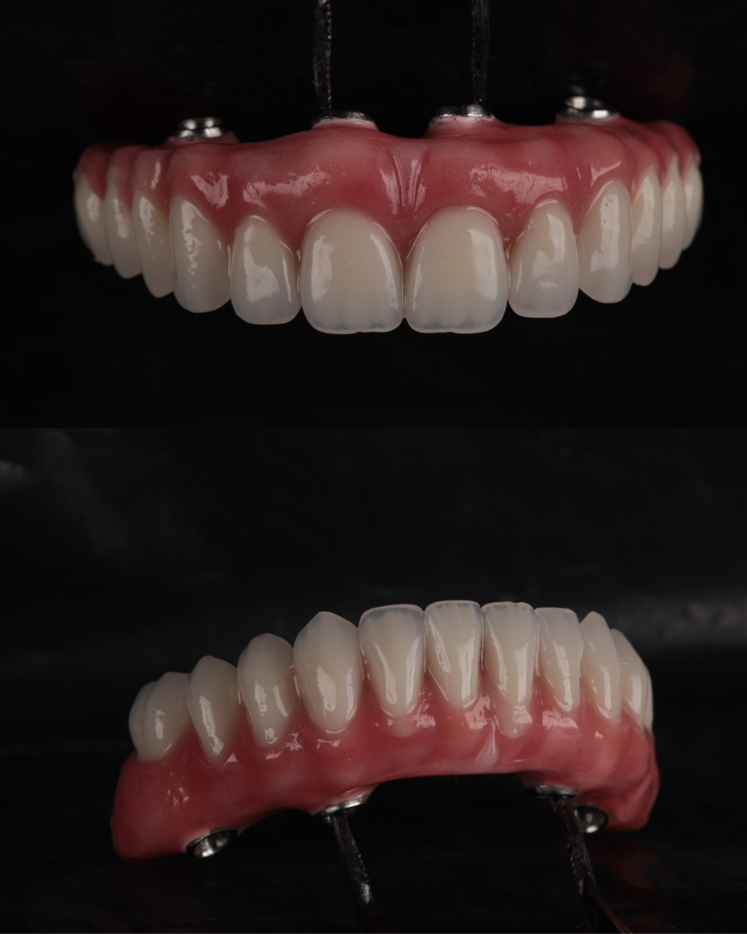 Implantes Dentários