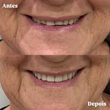 Reabilitação oral superior — estética e função