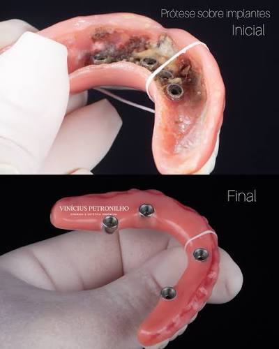 Protocolo de prótese total fixa sobre implantes