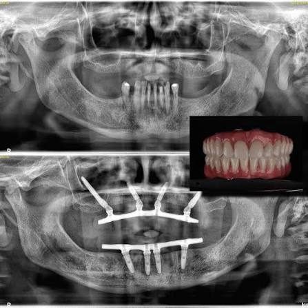 Radiografia panorâmica usada no planejamento cirúrgico